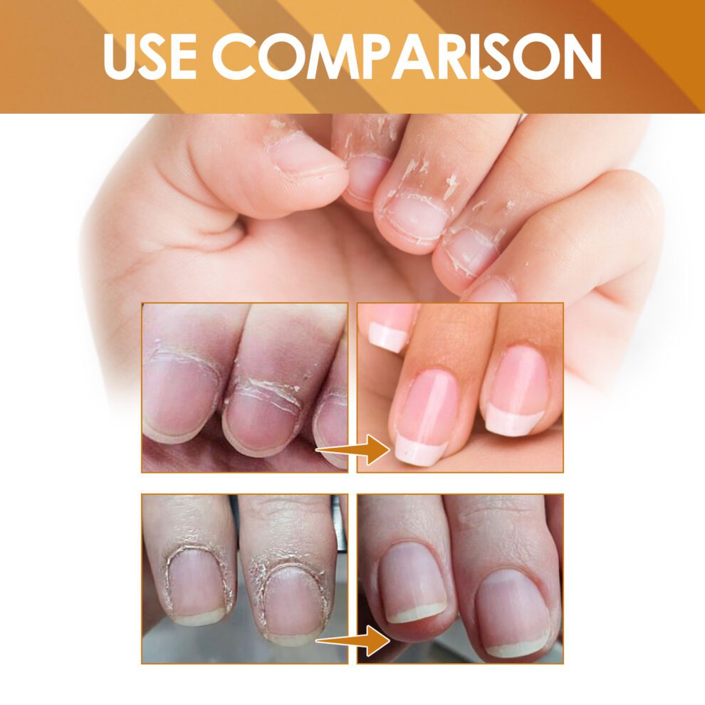 EELHOE Cuticle Care Gel: Aloe & Vitamin E for Soft, Healthy Nails - Image 3