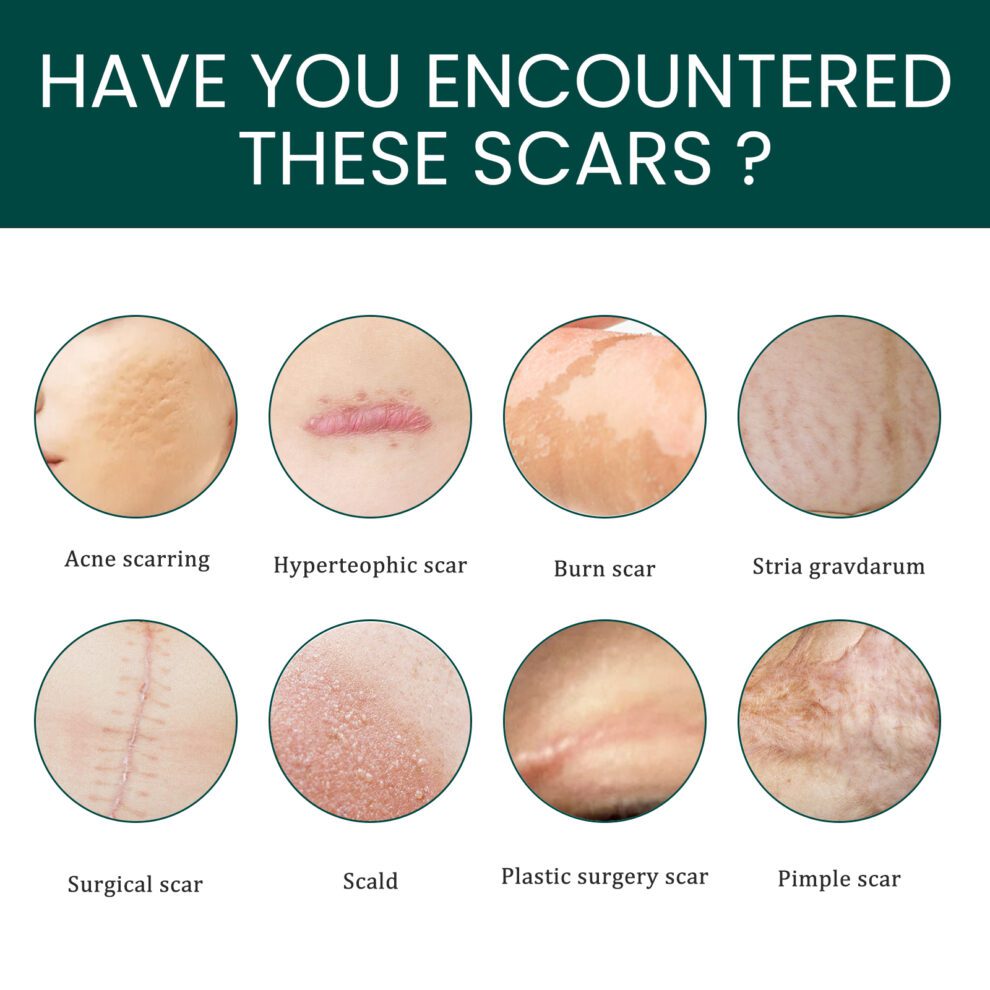 EELHOE Silicone Scar Care Patch - Gentle Daily Nurture & Invisible - Image 4