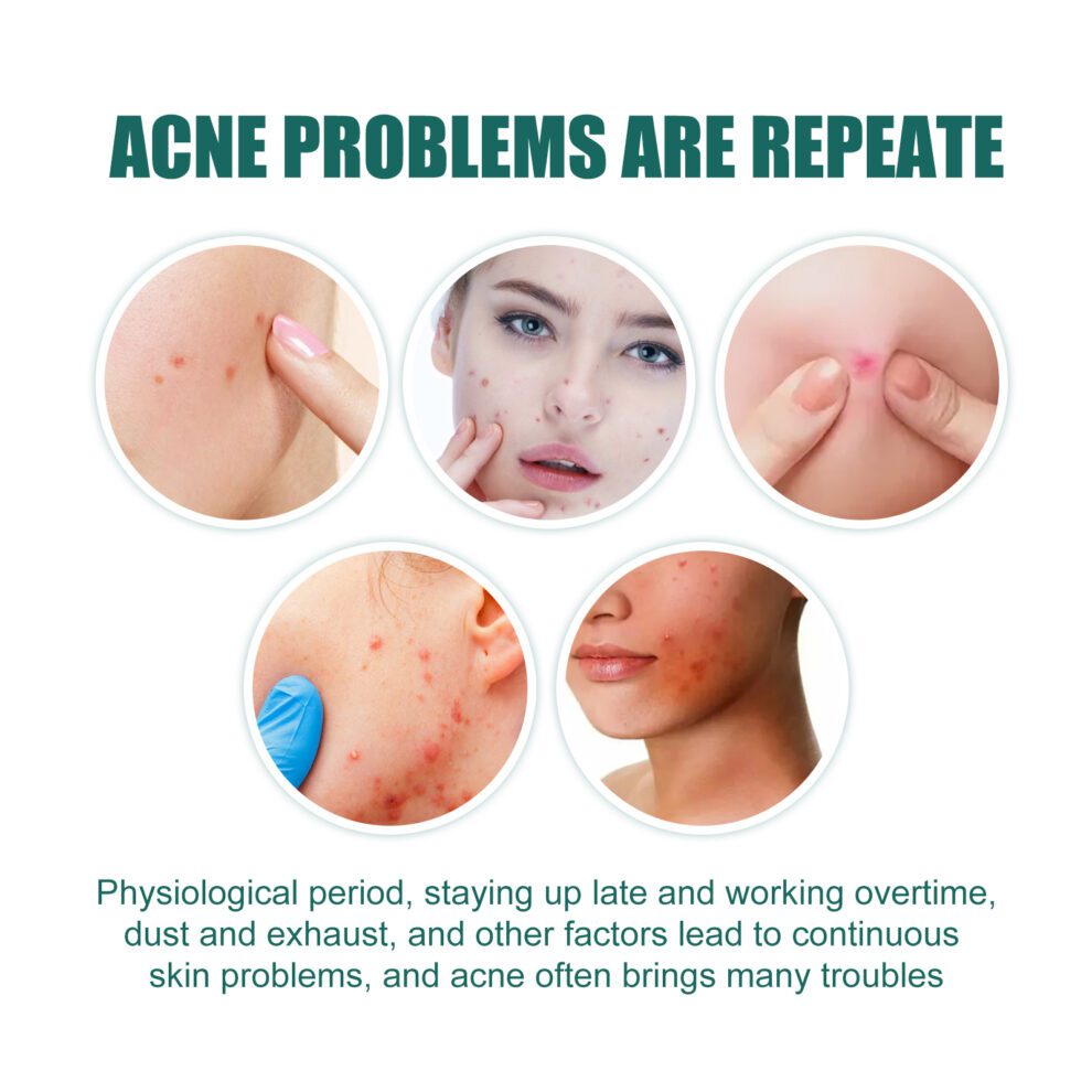 EELHOE Star Acne Patch - Gentle Natural Care for Calm, Clear Skin - Image 3