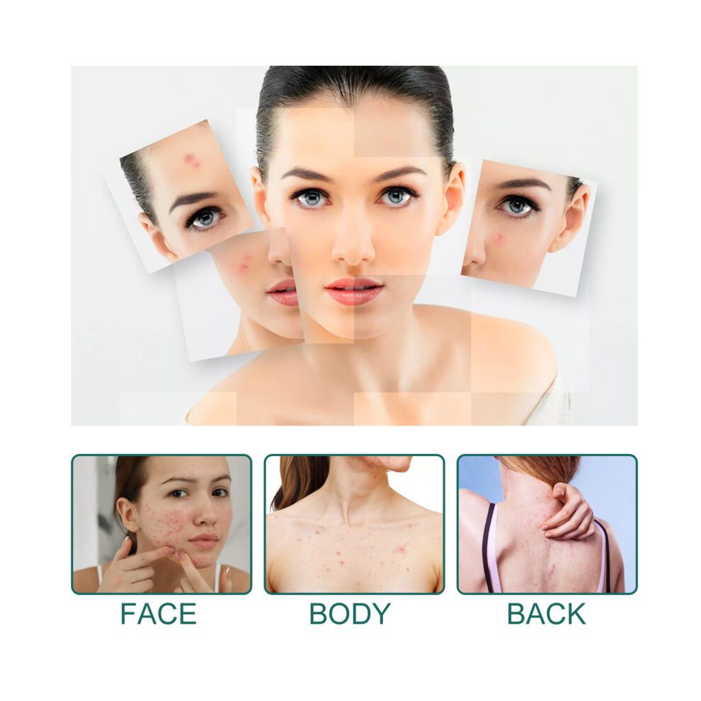 EELHOE Star Acne Patch - Gentle Natural Care for Calm, Clear Skin - Image 4