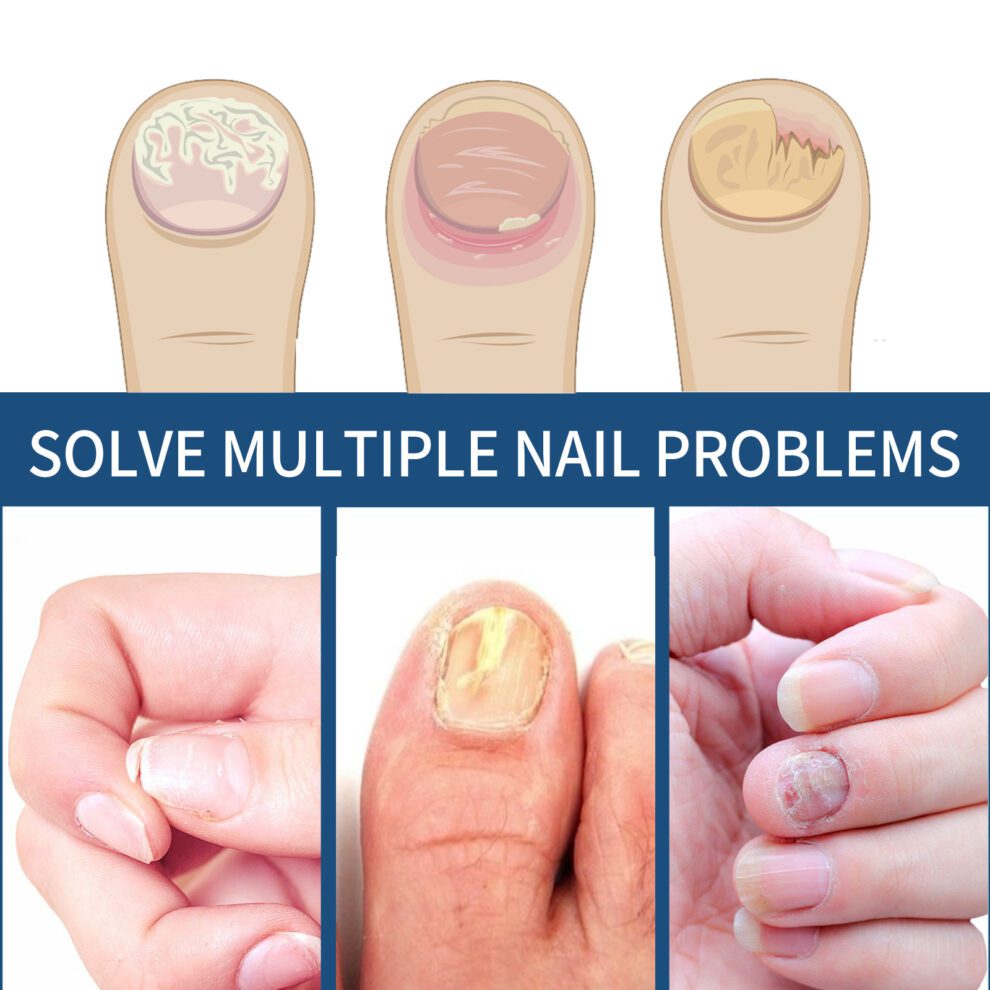 EELHOE Toenail Care Patch - Natural Daily Nurture for Smooth Nails - Image 4