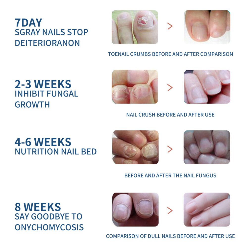 EELHOE Toenail Care Patch - Natural Daily Nurture for Smooth Nails - Image 5